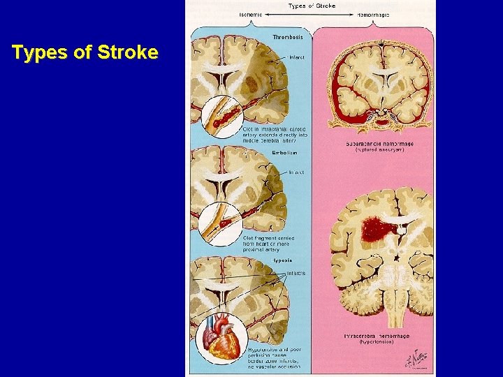 Types of Stroke 
