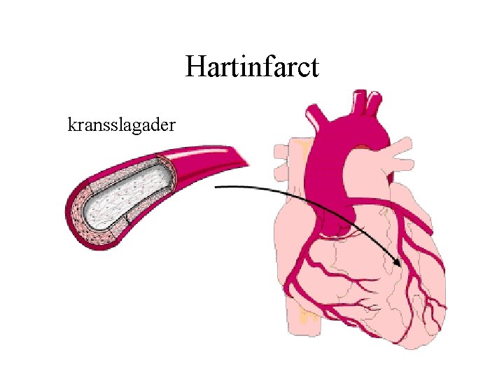 Hartinfarct kransslagader 