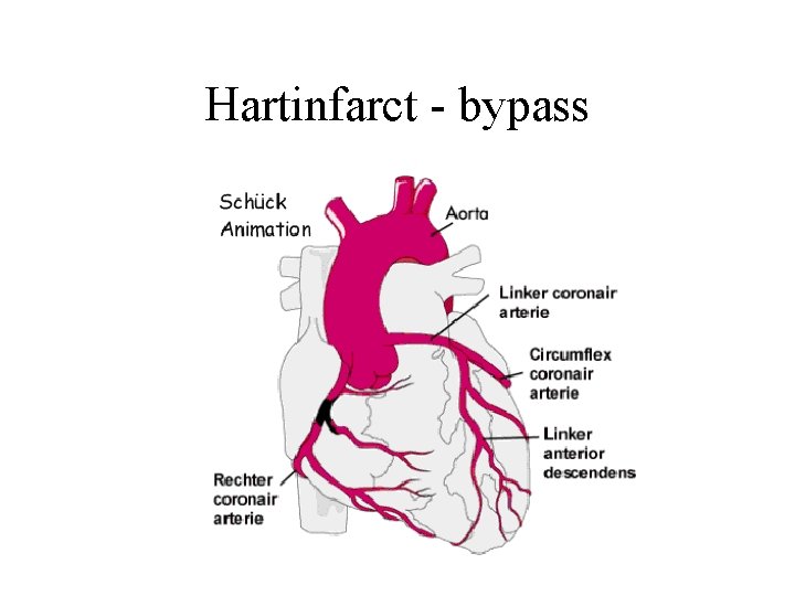 Hartinfarct - bypass 