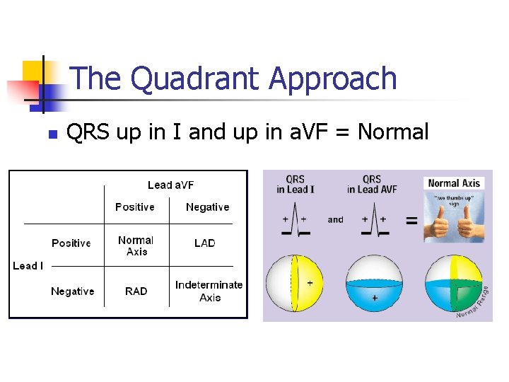 The Quadrant Approach n QRS up in I and up in a. VF =