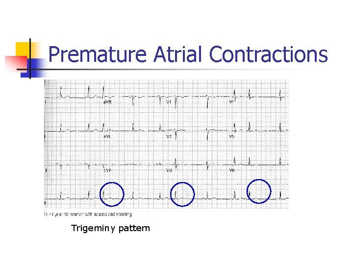 Premature Atrial Contractions Trigeminy pattern Premature Atrial Contractions Trigeminy pattern