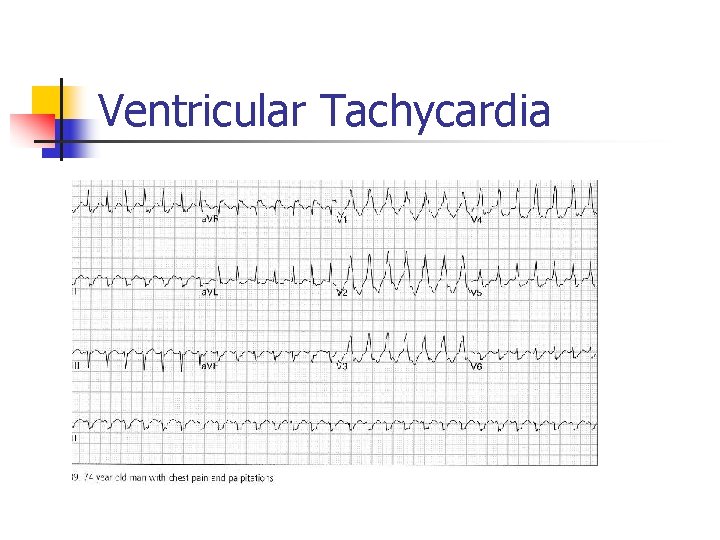 Ventricular Tachycardia Ventricular Tachycardia