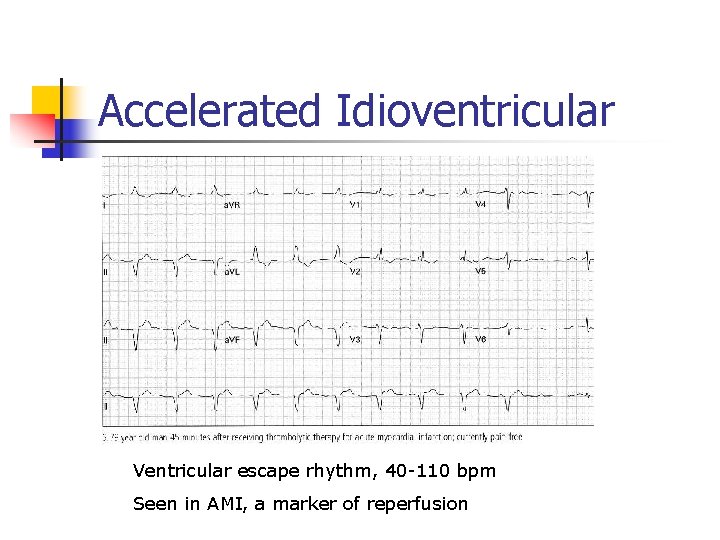 Accelerated Idioventricular Ventricular escape rhythm, 40 -110 bpm Seen in AMI, a marker of