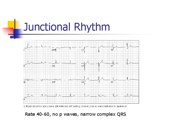 Junctional Rhythm Rate 40 -60, no p waves, narrow complex QRS Junctional Rhythm Rate 40 -60, no p waves, narrow complex QRS