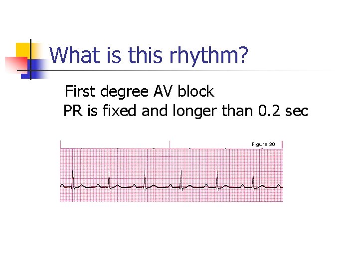 What is this rhythm? First degree AV block PR is fixed and longer than What is this rhythm? First degree AV block PR is fixed and longer than