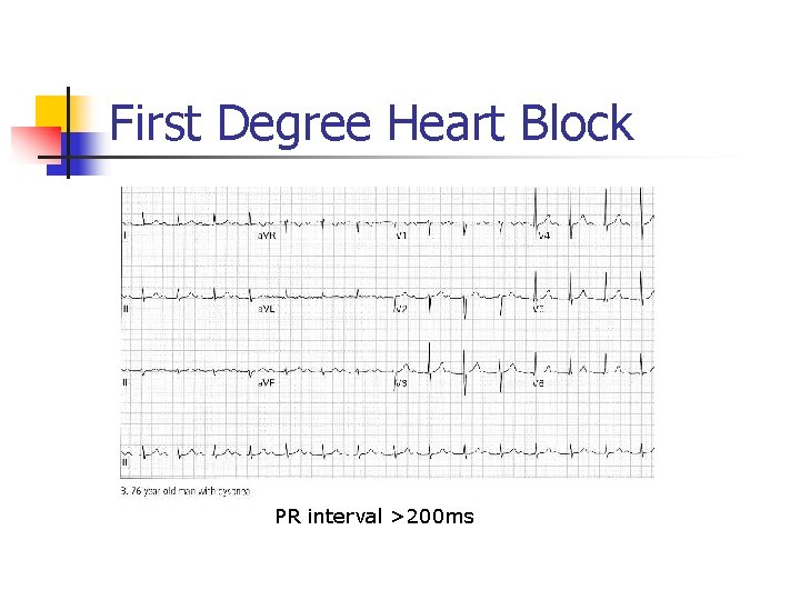 First Degree Heart Block PR interval >200 ms 