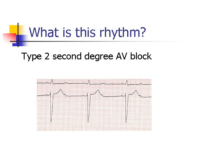 What is this rhythm? Type 2 second degree AV block What is this rhythm? Type 2 second degree AV block