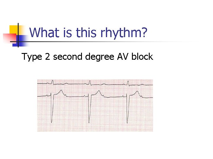 What is this rhythm? Type 2 second degree AV block 