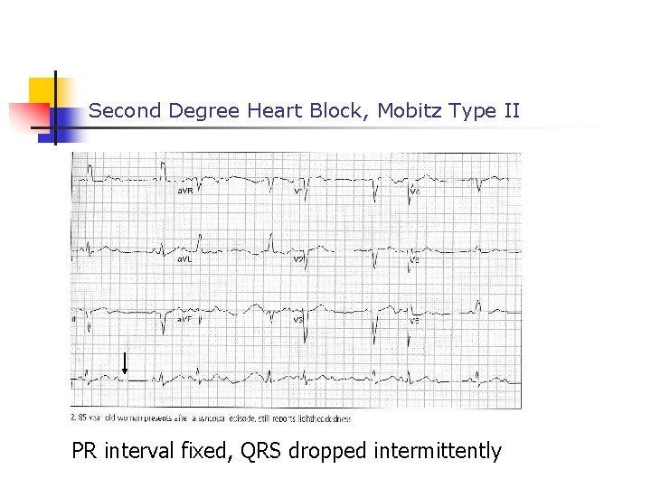 Second Degree Heart Block, Mobitz Type II PR interval fixed, QRS dropped intermittently 