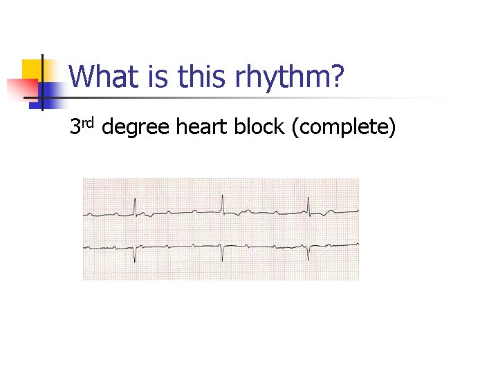 What is this rhythm? 3 rd degree heart block (complete) What is this rhythm? 3 rd degree heart block (complete)