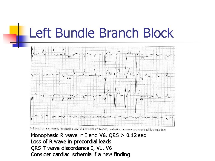 Left Bundle Branch Block Monophasic R wave in I and V 6, QRS >