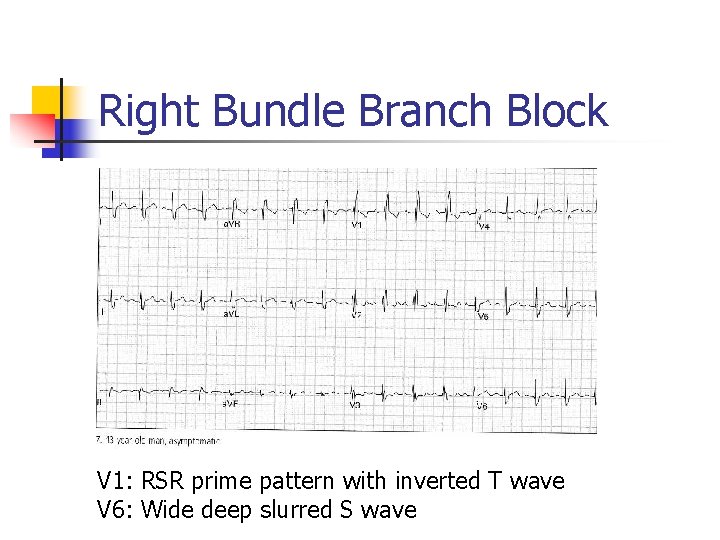 Right Bundle Branch Block V 1: RSR prime pattern with inverted T wave V