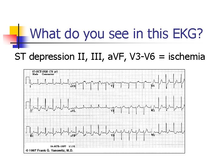 What do you see in this EKG? ST depression II, III, a. VF, V What do you see in this EKG? ST depression II, III, a. VF, V