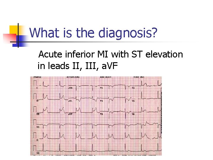 What is the diagnosis? Acute inferior MI with ST elevation in leads II, III, What is the diagnosis? Acute inferior MI with ST elevation in leads II, III,