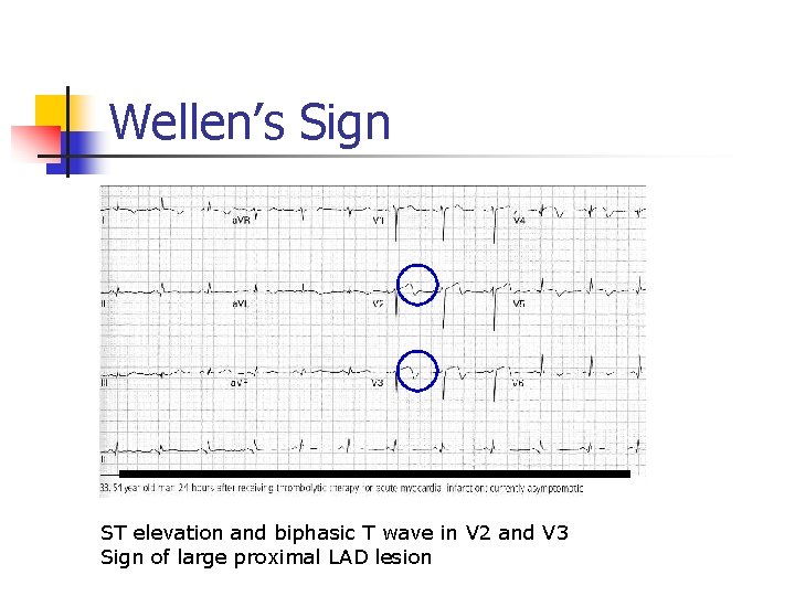 Wellen’s Sign ST elevation and biphasic T wave in V 2 and V 3