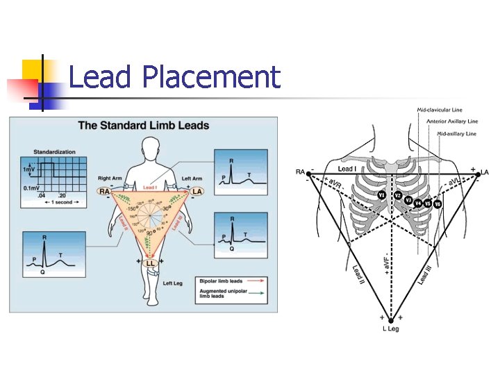 Lead Placement a. VF 