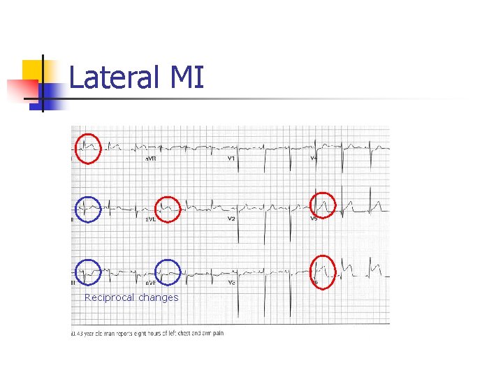 Lateral MI Reciprocal changes Lateral MI Reciprocal changes
