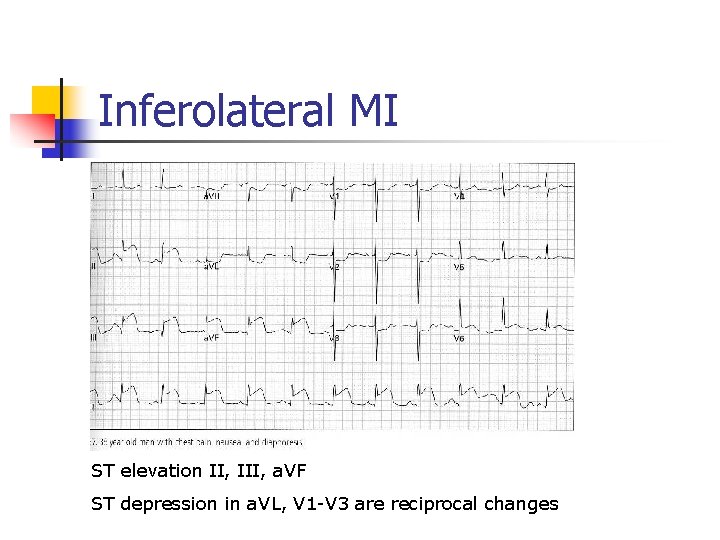 Inferolateral MI ST elevation II, III, a. VF ST depression in a. VL, V