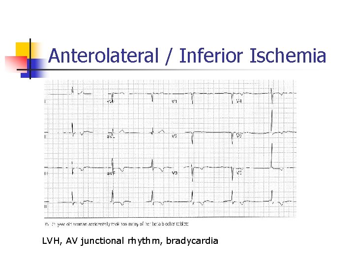 Anterolateral / Inferior Ischemia LVH, AV junctional rhythm, bradycardia 