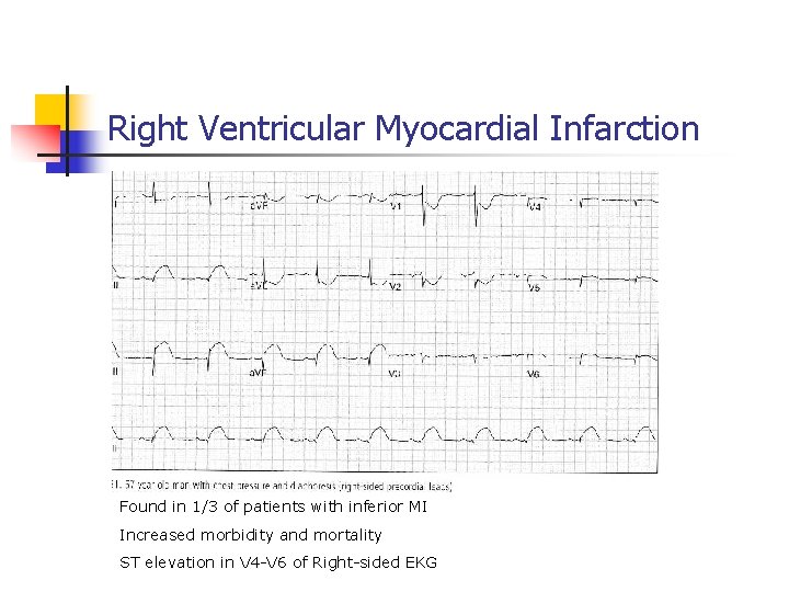 Right Ventricular Myocardial Infarction Found in 1/3 of patients with inferior MI Increased morbidity