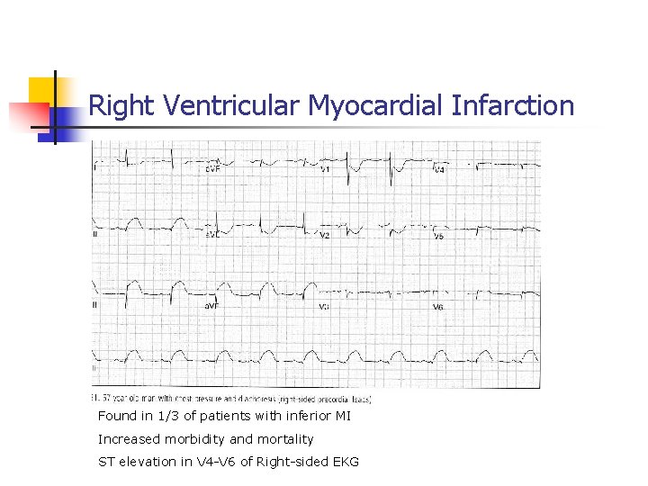 Right Ventricular Myocardial Infarction Found in 1/3 of patients with inferior MI Increased morbidity Right Ventricular Myocardial Infarction Found in 1/3 of patients with inferior MI Increased morbidity