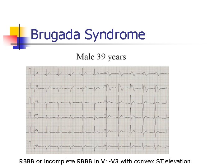 Brugada Syndrome RBBB or incomplete RBBB in V 1 -V 3 with convex ST