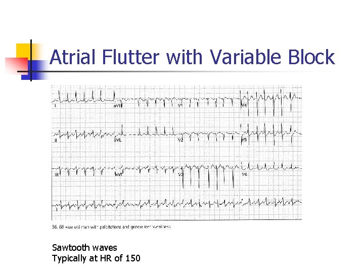Atrial Flutter with Variable Block Sawtooth waves Typically at HR of 150 