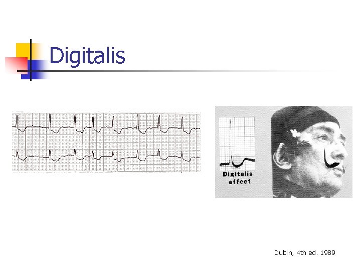 Digitalis Dubin, 4 th ed. 1989 