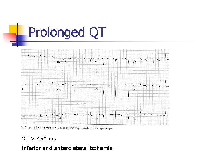 Prolonged QT QT > 450 ms Inferior and anterolateral ischemia 