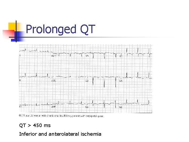 Prolonged QT QT > 450 ms Inferior and anterolateral ischemia Prolonged QT QT > 450 ms Inferior and anterolateral ischemia