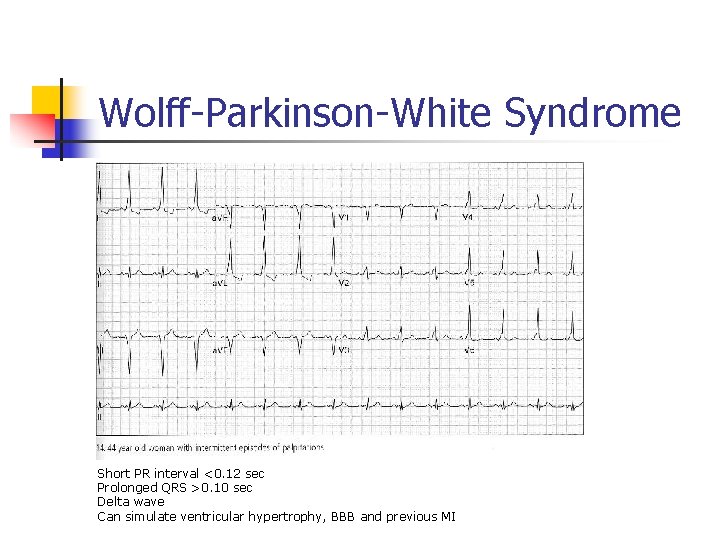 Wolff-Parkinson-White Syndrome Short PR interval <0. 12 sec Prolonged QRS >0. 10 sec Delta