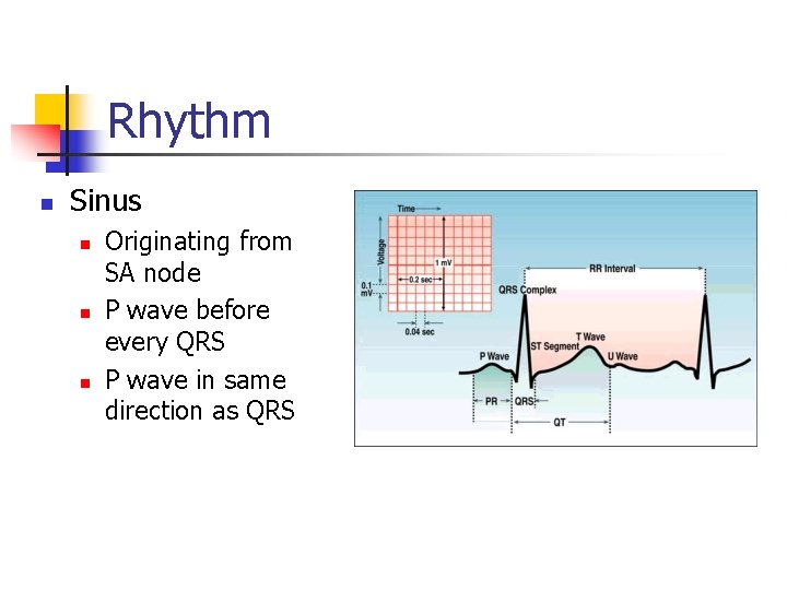 Rhythm n Sinus n n n Originating from SA node P wave before every