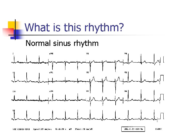 What is this rhythm? Normal sinus rhythm 