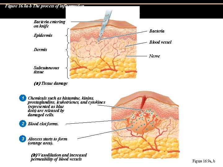 Figure 16. 8 a-b The process of inflammation. Inflammation Bacteria entering on knife Epidermis