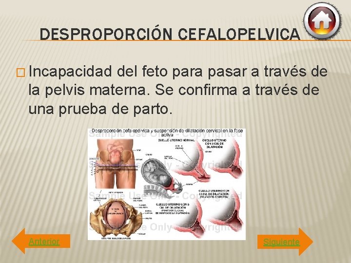 DESPROPORCIÓN CEFALOPELVICA � Incapacidad del feto para pasar a través de la pelvis materna.