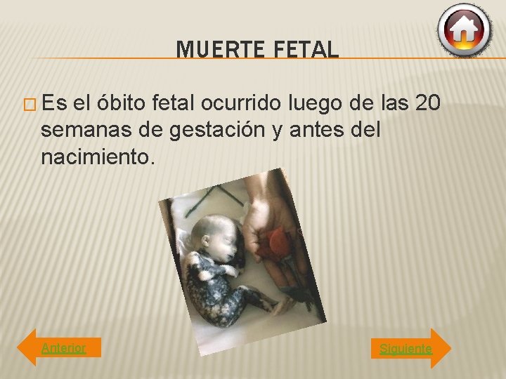 MUERTE FETAL � Es el óbito fetal ocurrido luego de las 20 semanas de