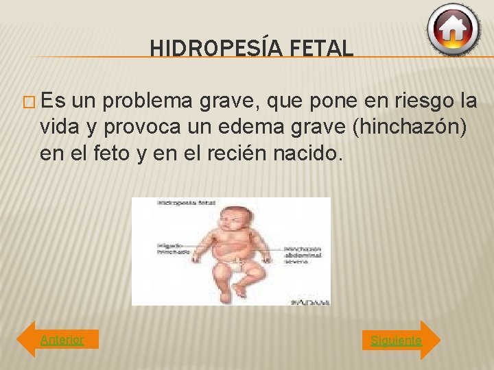 HIDROPESÍA FETAL � Es un problema grave, que pone en riesgo la vida y