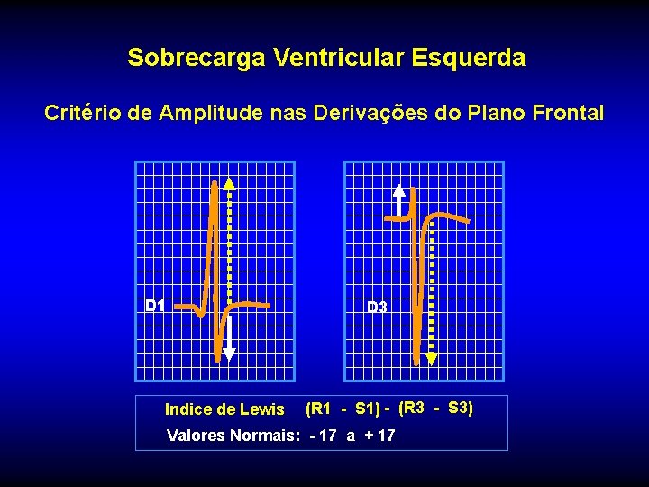 Sobrecarga Ventricular Esquerda Critério de Amplitude nas Derivações do Plano Frontal D 1 D