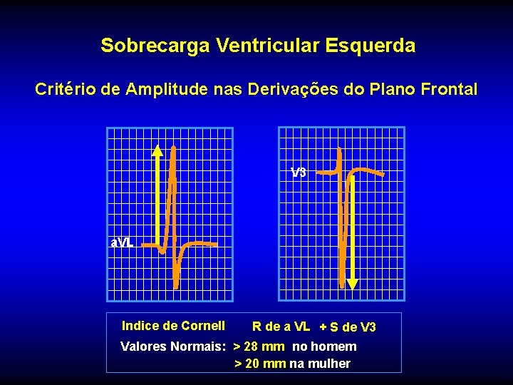 Sobrecarga Ventricular Esquerda Critério de Amplitude nas Derivações do Plano Frontal V 3 a.