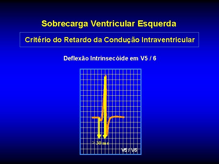 Sobrecarga Ventricular Esquerda Critério do Retardo da Condução Intraventricular Deflexão Intrinsecóide em V 5