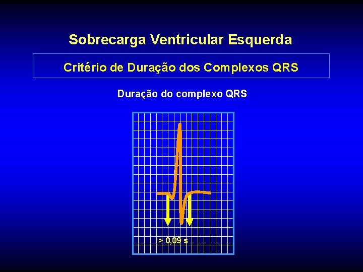 Sobrecarga Ventricular Esquerda Critério de Duração dos Complexos QRS Duração do complexo QRS >