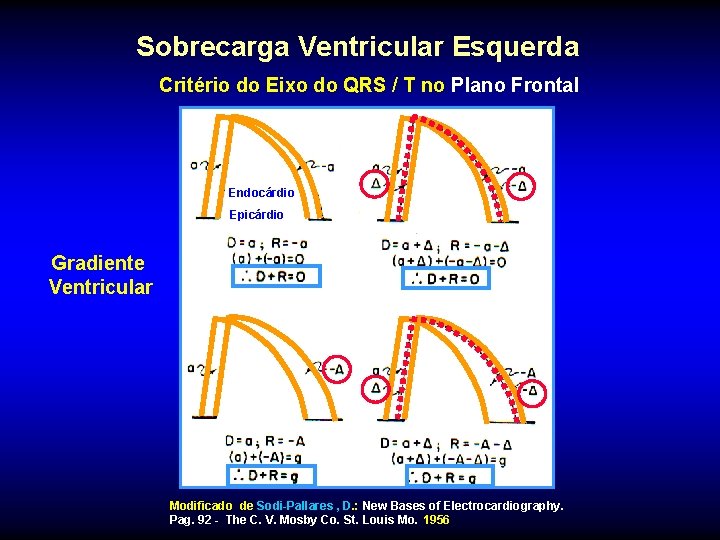 Sobrecarga Ventricular Esquerda Critério do Eixo do QRS / T no Plano Frontal Endocárdio