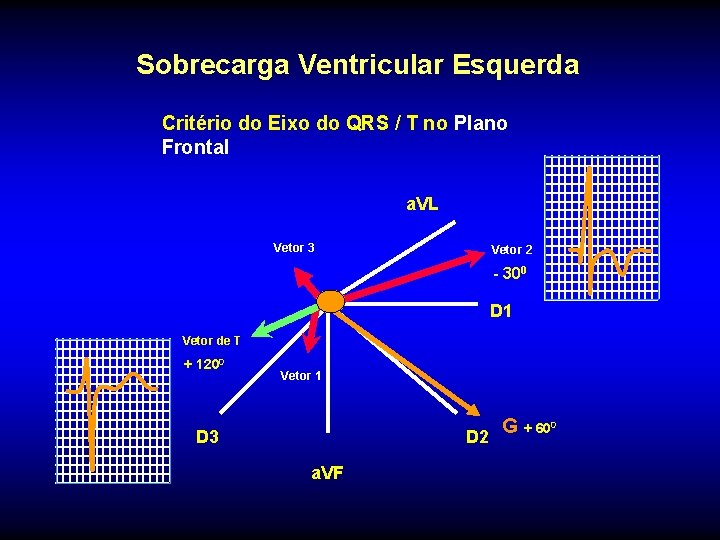 Sobrecarga Ventricular Esquerda Critério do Eixo do QRS / T no Plano Frontal a.