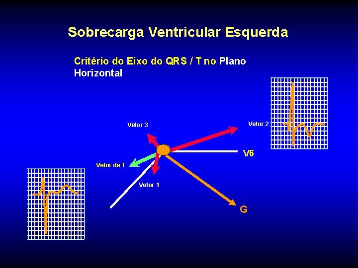 Sobrecarga Ventricular Esquerda Critério do Eixo do QRS / T no Plano Horizontal Vetor