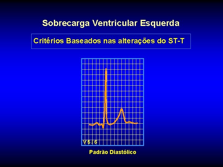 Sobrecarga Ventricular Esquerda Critérios Baseados nas alterações do ST-T V 5/6 Padrão Diastólico 