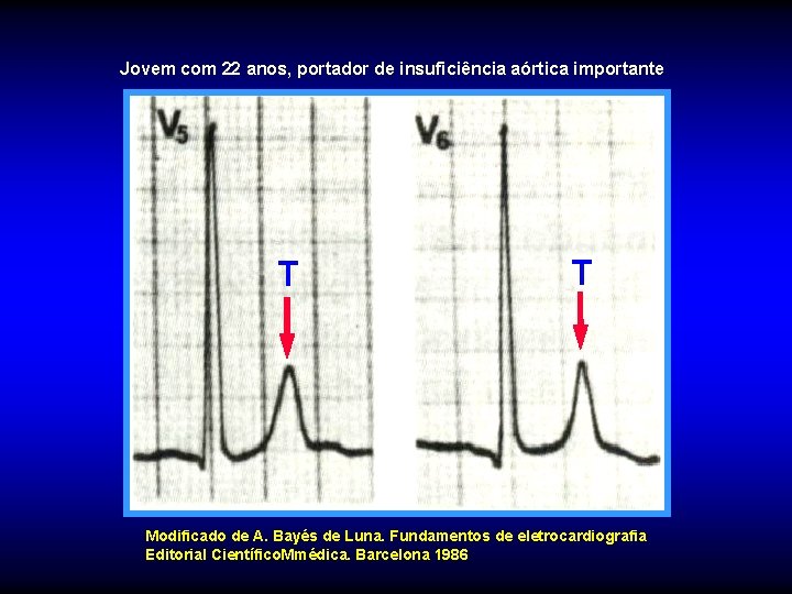 Jovem com 22 anos, portador de insuficiência aórtica importante T T Modificado de A.