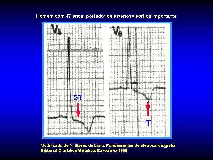 Homem com 47 anos, portador de estenose aórtica importante T ST T Modificado de