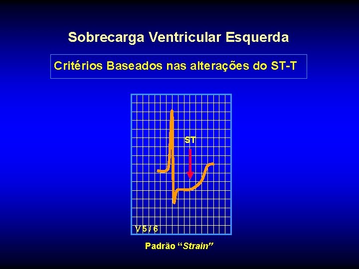 Sobrecarga Ventricular Esquerda Critérios Baseados nas alterações do ST-T ST V 5/6 Padrão “Strain”
