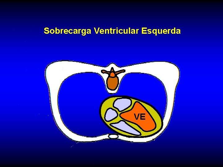 Sobrecarga Ventricular Esquerda VE 