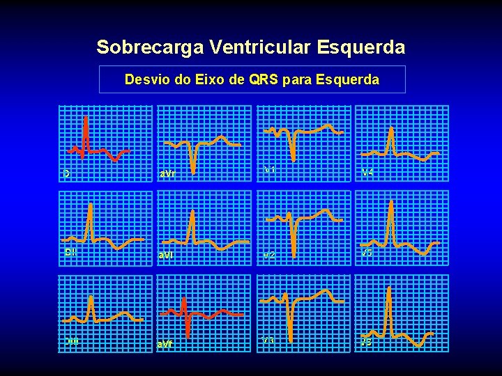 Sobrecarga Ventricular Esquerda Desvio do Eixo de QRS para Esquerda DI a. Vr V